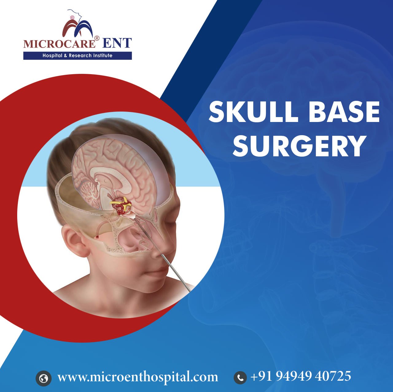 Skull Base Surgery approaches in Hyderabad, India | MicrocareENT