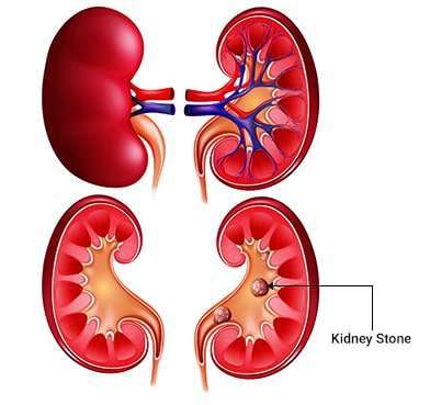 Kidney Stone Surgery in Delhi