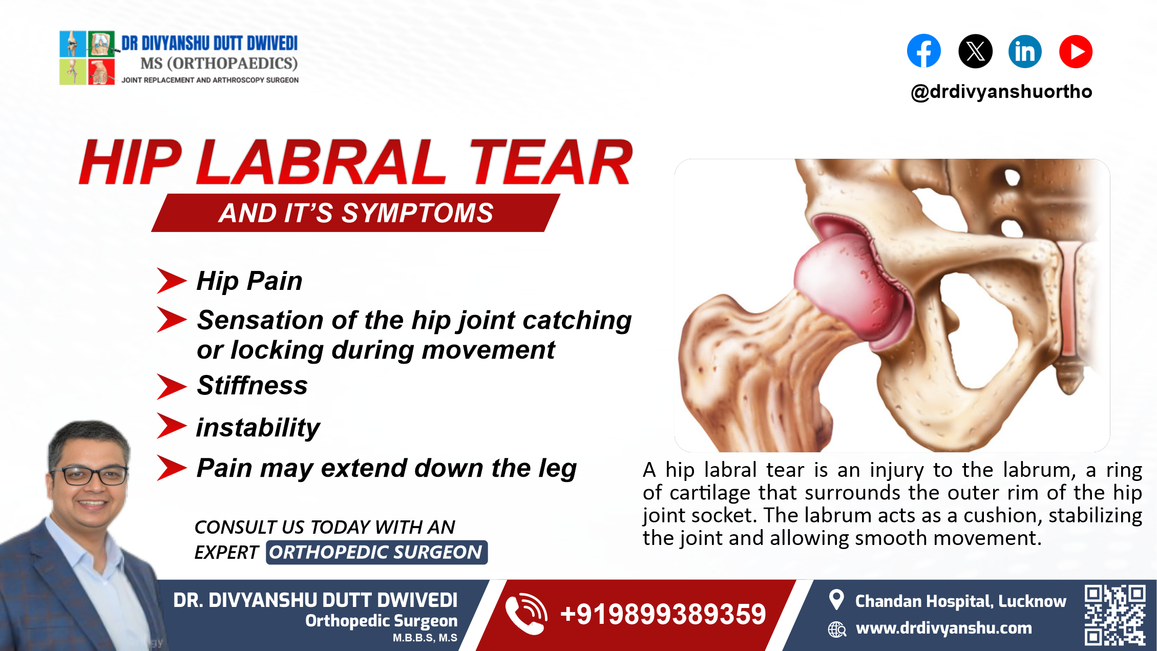 Hip Labral Tear and Its Symptoms